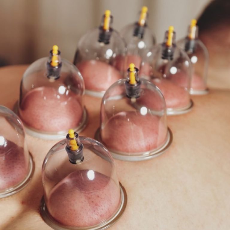 Cupping Therapy